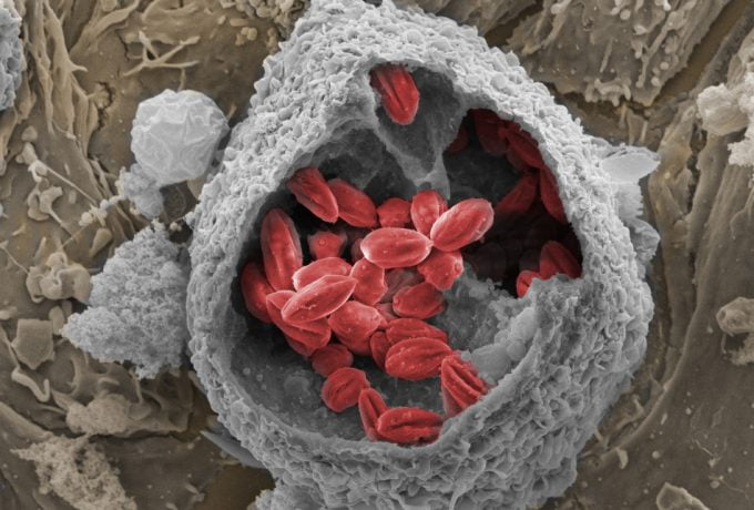 Imagem ampliada 7.500 vezes mostra as bolsas (vacúolos) formados pelo protozoário L. amazonensis (vermelho), agente causador da leishmaniose cutânea, dentro de macrófago de camundongo (cinza). Créditos: Revista Pesquisa Fapesp