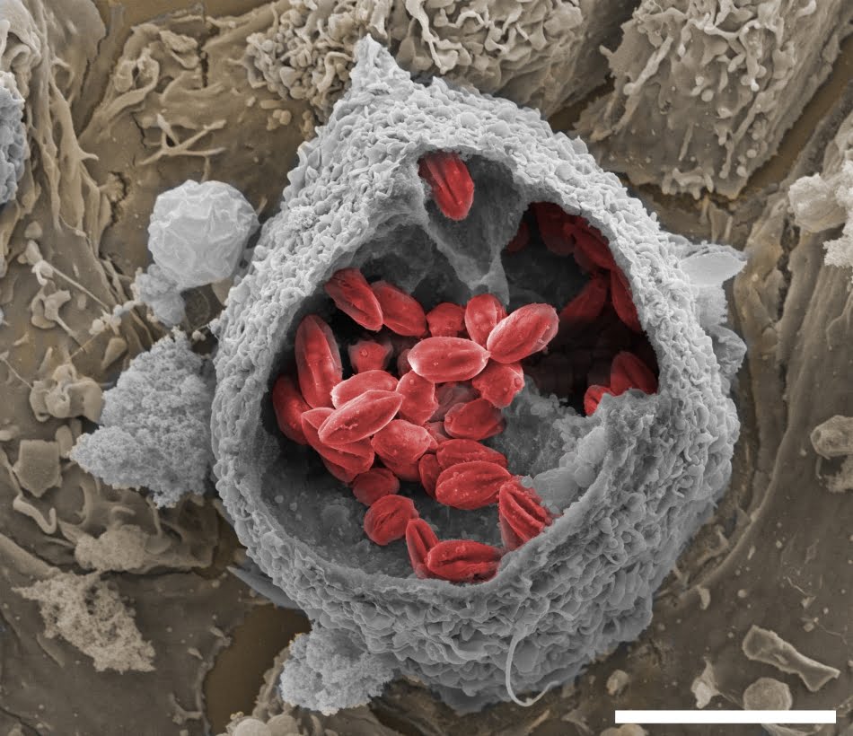 Combate à leishmaniose 1 Imagem ampliada 7.500 vezes mostra as bolsas (vacúolos) formados pelo protozoário L. amazonensis (vermelho), agente causador da leishmaniose cutânea, dentro de macrófago de camundongo (cinza). Créditos: Revista Pesquisa Fapesp